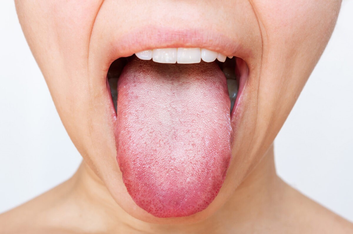 زبان سالم - تشخیص بیماری از روی زبان