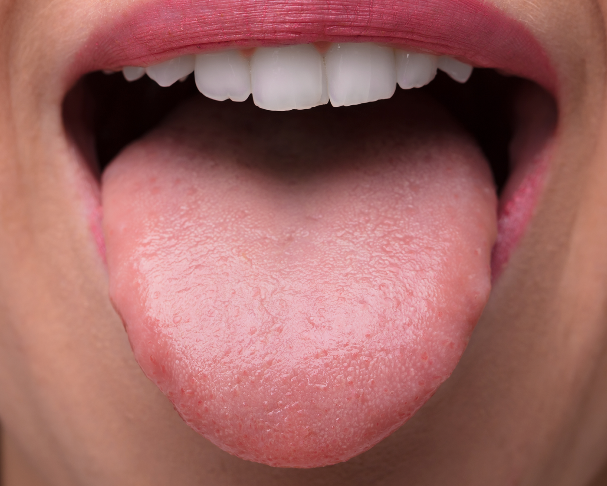 تشخیص زبان سالم - تشخیص بیماری از روی زبان